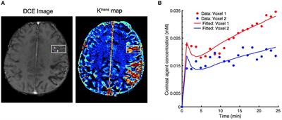 Convolutional Neural Networks for Direct Inference of Pharmacokinetic Parameters: Application to Stroke Dynamic Contrast-Enhanced MRI